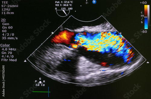 Canvastavla Echocardiography (ultrasound) machine. doppler of aortic stenosis