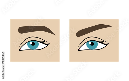 Correction of shape of eyebrows before and after