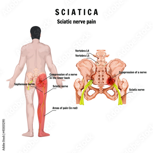 Sciatica – symptoms and causes, medical illustration of sciatic nerve. Neuropathy - sciatic nerve. Sciatic nerve dysfunction. LBP.
 photo