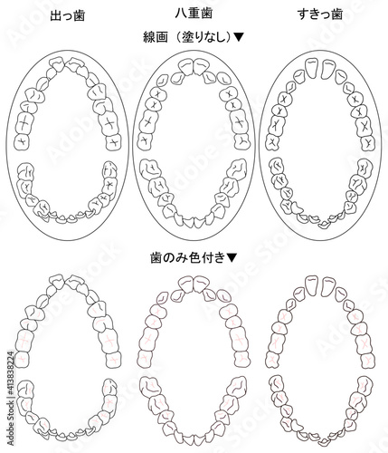 歯列矯正治療の対象になる代表的な症例を上から見た図セット
