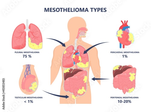 Asbestos breath chest pain testes ascites Hydrocele scrotum Swollen Difficulty fluid pleura testicle tunica vaginalis dust tract safe safety carcinogen smoking hazard danger tissue toxic silica copd