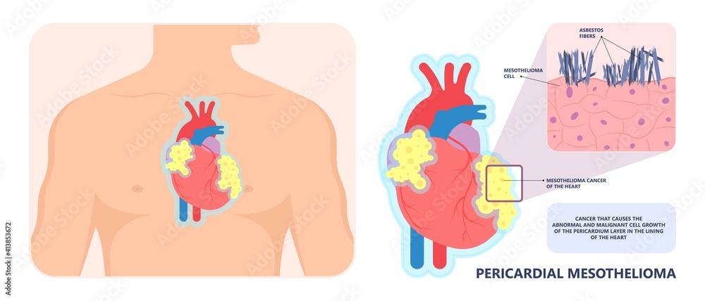 Asbestos breath chest pain testes ascites Hydrocele scrotum Swollen Difficulty fluid pleura testicle tunica vaginalis dust tract safe safety carcinogen smoking hazard danger tissue toxic silica copd Asbestos breath chest pain testes ascites Hydrocele scrotum Swollen Difficulty fluid pleura testicle tunica vaginalis dust tract safe safety carcinogen smoking hazard danger tissue toxic silica copd