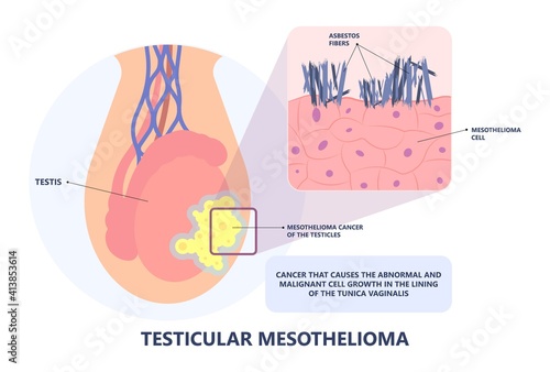 Asbestos breath chest pain testes ascites Hydrocele scrotum Swollen Difficulty fluid pleura testicle tunica vaginalis dust tract safe safety carcinogen smoking hazard danger tissue toxic silica copd