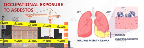 Asbestos breath chest pain testes ascites Hydrocele scrotum Swollen Difficulty fluid pleura testicle tunica vaginalis dust tract safe safety carcinogen smoking hazard danger tissue toxic silica copd