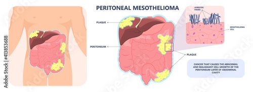 Asbestos breath chest pain testes ascites Hydrocele scrotum Swollen Difficulty fluid pleura testicle tunica vaginalis dust tract safe safety carcinogen smoking hazard danger tissue toxic silica copd