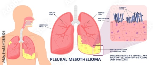 Asbestos breath chest pain testes ascites Hydrocele scrotum Swollen Difficulty fluid pleura testicle tunica vaginalis dust tract safe safety carcinogen smoking hazard danger tissue toxic silica copd