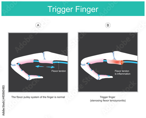 Trigger finger. illustration explain a symptom of locked finger caused by a problem with the tendon of human finger which can not inability to move fingers. illustration..