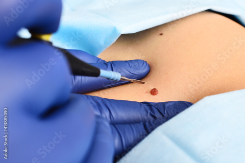 A dermatologist surgeon removes a neoplasm - a mole or nevus from the patient s abdomen with a radio wave knife. Aesthetic surgery  prevention of melanoma.