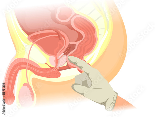 Digital rectal examination vector illustration. Illustration of the finger eximining the prostate photo