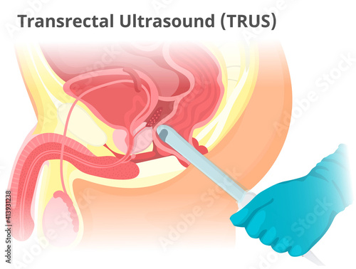 Illustration of the TRUS. Transrectal prostate ultrasound examination procedure