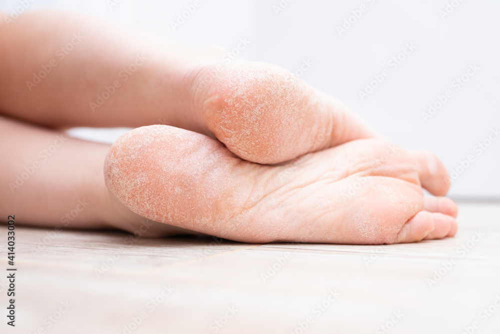The dry skin on the feet is cracked. Treatment concept with moisturizing creams and exfoliation for healing wounds and pain when walking. Dehydrated skin on the heels of female feet