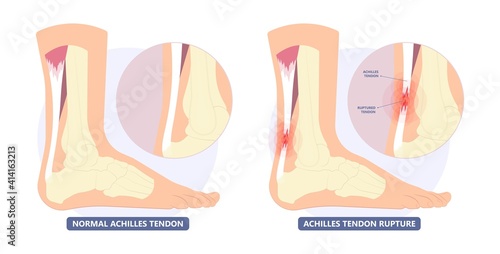 Achilles tendon rupture injury Feet calf test range of motion slight ache problem limb Thompson Simmonds	 photo
