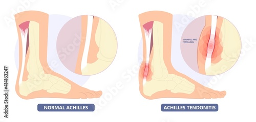Achilles tendon rupture injury Feet calf test range of motion slight ache problem limb Thompson Simmonds	