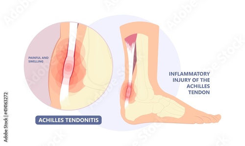 Achilles tendon rupture injury Feet calf test range of motion slight ache problem limb Thompson Simmonds	
