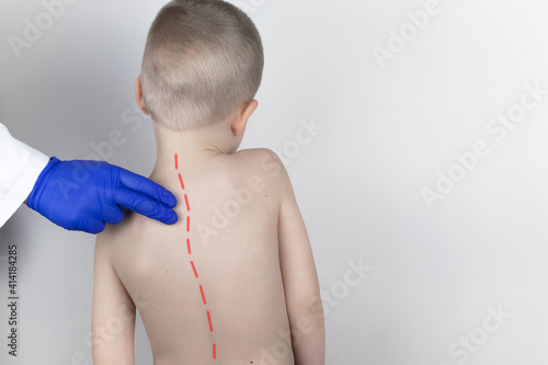 A little boy at the doctor's appointment with back pain. Treatment of spinal deformity and stoop. Osteoporosis, kyphosis, lordosis, or scoliosis. photo