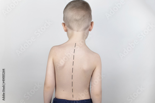 A little boy at the doctor's appointment with back pain. Treatment of spinal deformity and stoop. Osteoporosis, kyphosis, lordosis, or scoliosis. photo