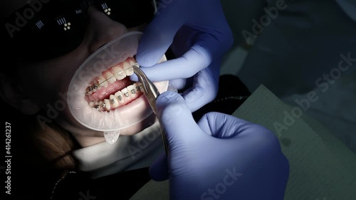 A patient with a mouth dilator in a dental chair, braces on his teeth, a doctor performs various procedures with the help of dental instruments. photo