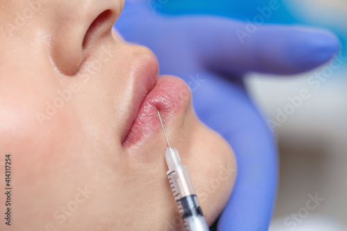 Close up Botox injection into the lips of a young girl. Lip augmentation. Needle and syringe. Injection in cosmetic surgery.