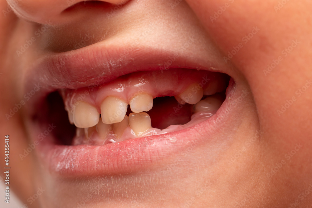 Fototapeta premium a baby's mouth with a missing milk tooth