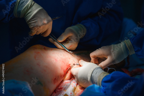 Phlebectomy operation. Surgical removal of veins