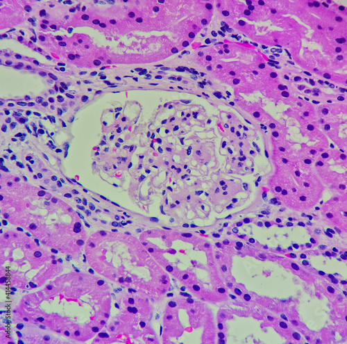 Photo of IgA nephropathy showing mesangial hypercellularity, magnification 400x, photo under microscope