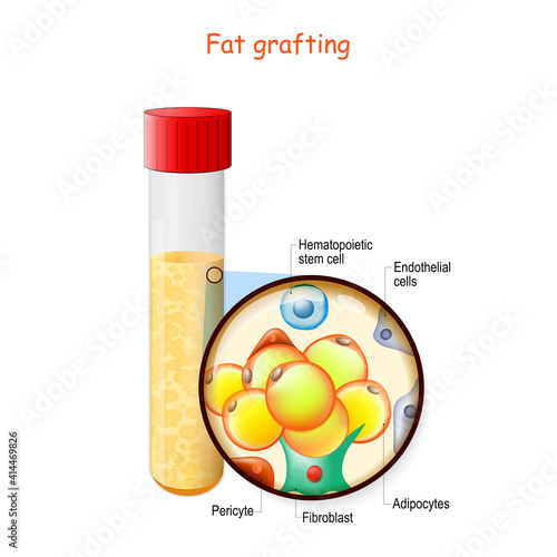 fat grafting structure. Test tube with fat.