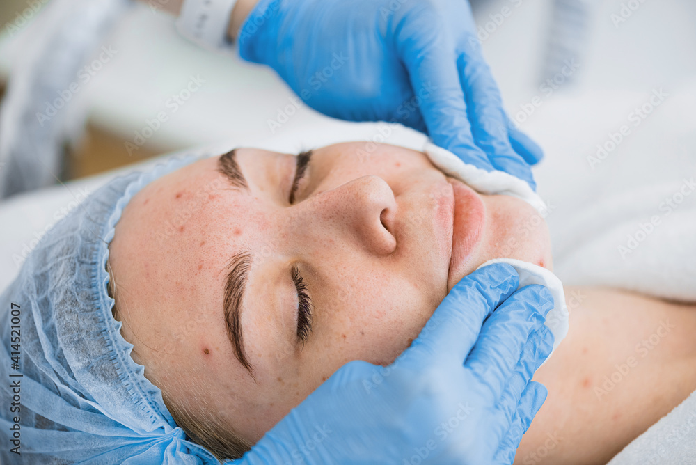 Sponge application of the mask on the face with problem skin Sponge application of the mask on the face with problem skin