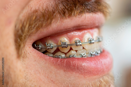 side view of face of man with mustache and beard using orthodontic appliance. Selective focus photo