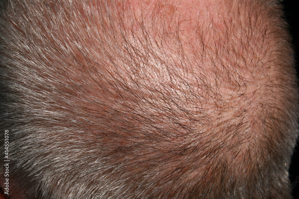 Bald Hair Bald Hair