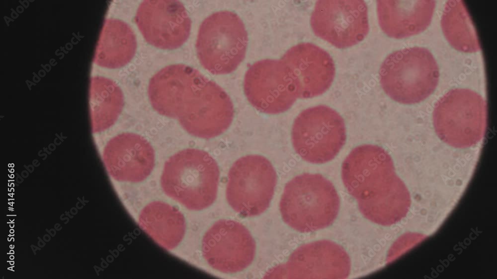 Blood cells under microscope, medical research, virus or cancer examination, testing for coronavirus antibody, concept. View through microscope lens, macro Blood cells under microscope, medical research, virus or cancer examination, testing for coronavirus antibody, concept. View through microscope lens, macro