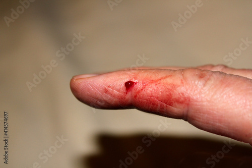 Hurt Finger