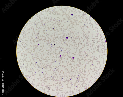 Microscopic blood film show low count of rbc wbc platelets called pancytopenia photo