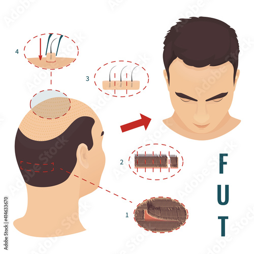 Male hair loss treatment with follicular unit transplantation. Stages of FUT procedure. Alopecia infographic medical design. Clinics and diagnostic centers concept design. Vector illustration.