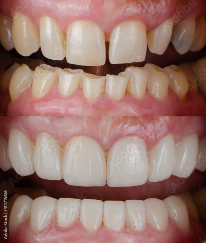 Before and After Dental smile makeover