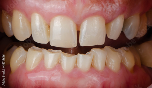 Broken, chipped, crooked, discoloration teeth