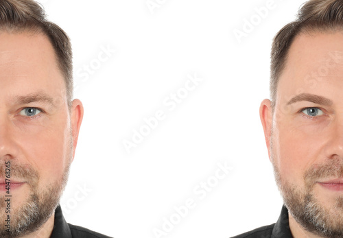 Man before and after eyebrow modeling on white background, collage photo