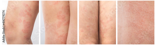 Panel Collage about acute atopic dermatitis on the legs of a child is a dermatological disease of the skin. Large, red, inflamed, scaly rash on the legs. Legs of a teenager with severe atopic eczema. photo