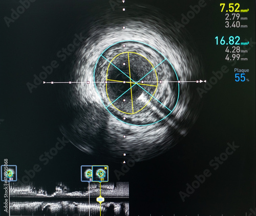 Intravascular ultrasound imaging (IVUS) at cardiac catheterization laboratory room. photo