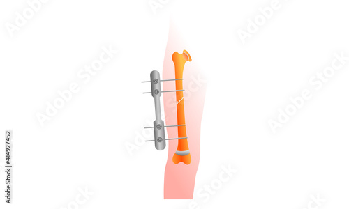 Broken thigh bone. External fixation. Fracture of the thigh bone and splint