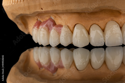 Close-up photo of a dental upper jaw prosthesis on black glass background. Artificial jaw with veneers and crowns. Tooth recovery with implant. Dentistry conceptual photo. Prosthetic dentistry.