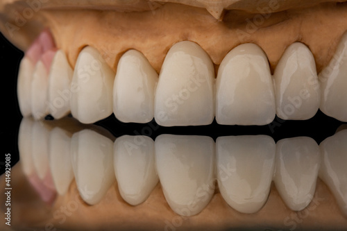 Close-up front view of a dental upper jaw prosthesis on black glass background. Artificial jaw with veneers and crowns. Tooth recovery with implant. Dentistry conceptual photo. Prosthetic dentistry.