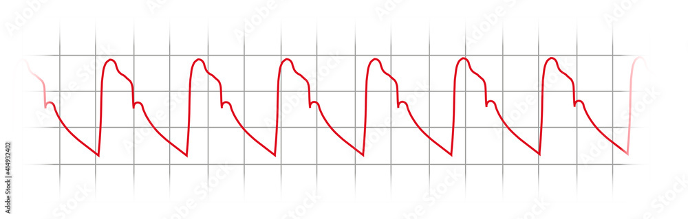 Naklejka premium Invasive Blood Pressure Waveform - Arterial pulse