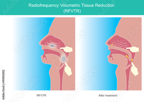 Radio frequency. Volumetric Tissue Reduction RFVTR. This illustration showing medical technology for treat Nasal obstruction and Snoring symptoms  by insert a tool into oral or nasal..