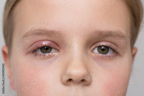 Selective focus, concept. Girl 10 years old close up portrait. One eye has barley. Grey background.