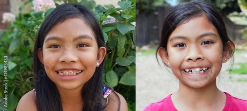 A girl with crooked teeth, and wearing braces of difent color.