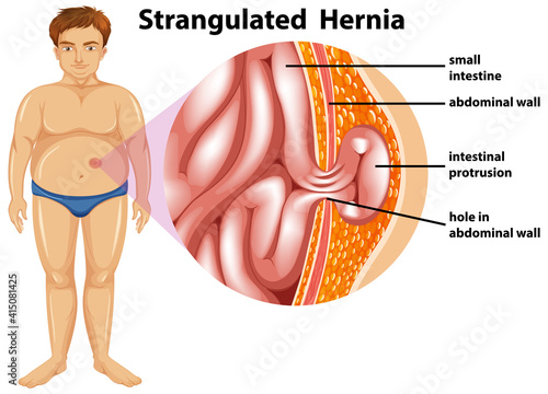Man with strangulated hernia