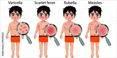 The skin of a boy with chickenpox, rubella, scarlet fever and measles. Difference between skin rashes. View of the rash through a magnifying glass. Vector illustration photo