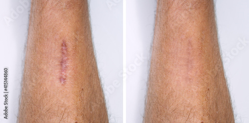 Fototapeta Result after procedure of scar removing