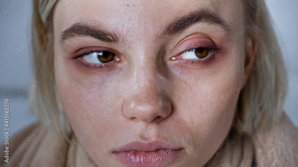 close up view of sick, upset woman looking away at home close up view of sick, upset woman looking away at home