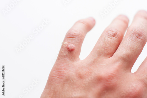 Closeup of finger wart isolated on white background. Skin diseases. Viral wart on hand